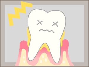歯ぎしりと歯周病
